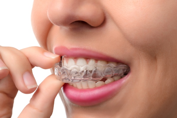 Benefits Of Clear Braces