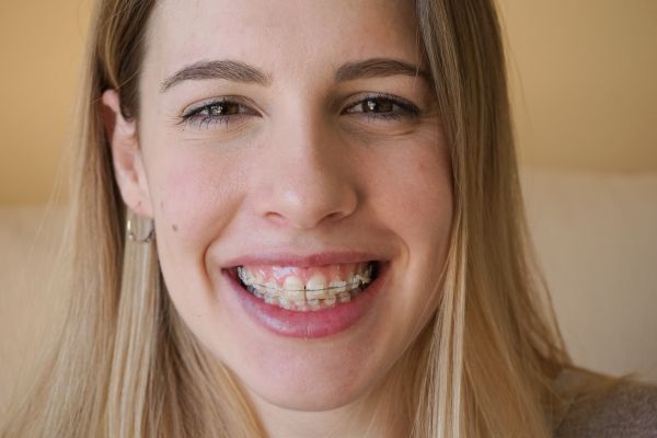 Clear Braces Vs  Aligners:   Important Differences To Keep In Mind