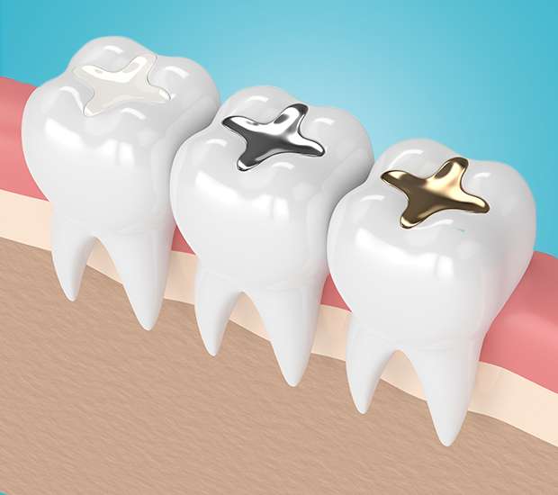 Marion Composite Fillings