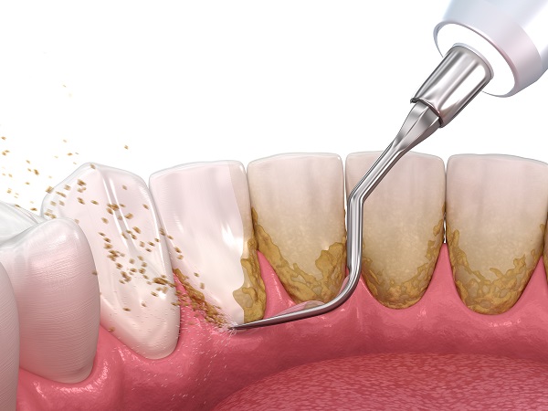 How Routine Dental Cleanings From Your Dentist Prevents Cavities