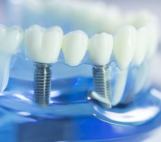 Marion Dental Implants