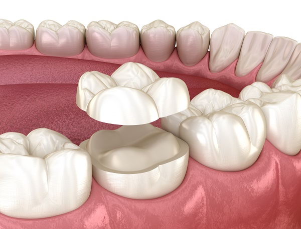 How Can A Dental Onlay Treat A Damaged Tooth?