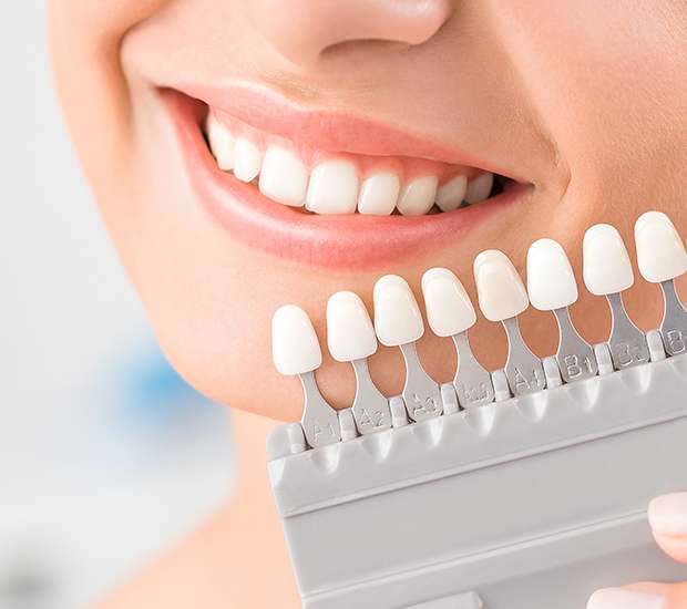 Marion Dental Veneers and Dental Laminates