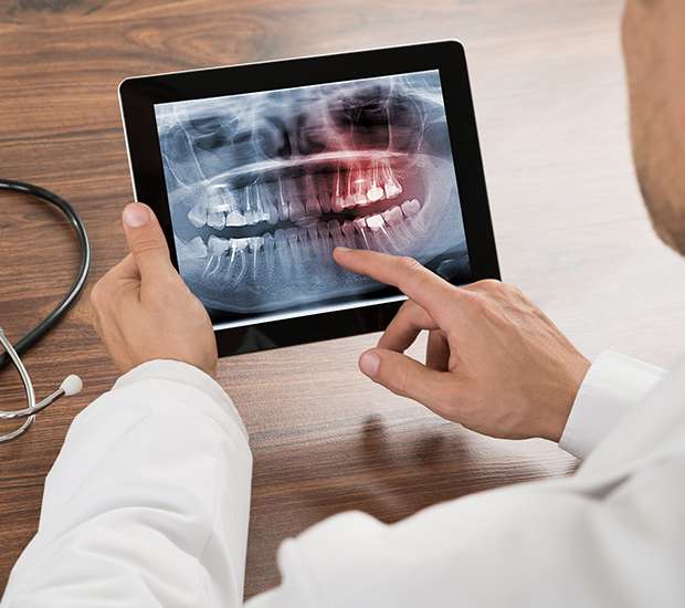 Marion Types of Dental Root Fractures